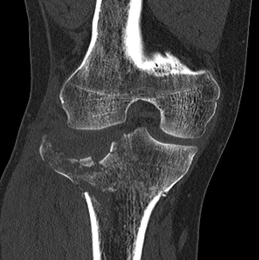 File:Tibial plateau fracture intra op 1.jpeg