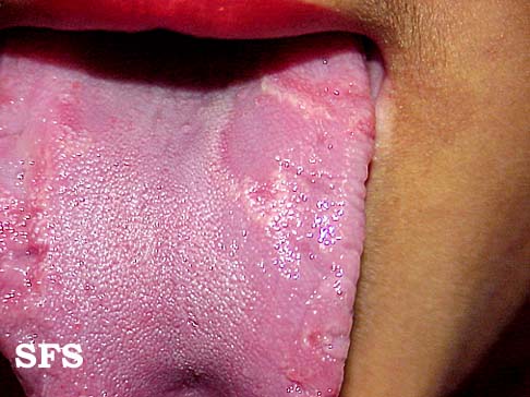 Tongue geographic. Adapted from Dermatology Atlas.[1]