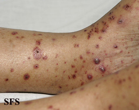 File:Allergicvasculitis10.jpg