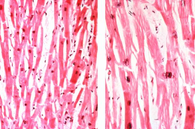 Normal myocardium (left) is compared here to hypertrophied myocardium (right). The muscle fibers are thicker and the nuclei are larger and darker in the hypertrophied myocardium.The clear spaces between the muscle fibers are due to processing artifacts and are not present during life.