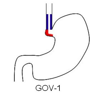 Gastroesophageal varices type 1, via Wikipedia.org