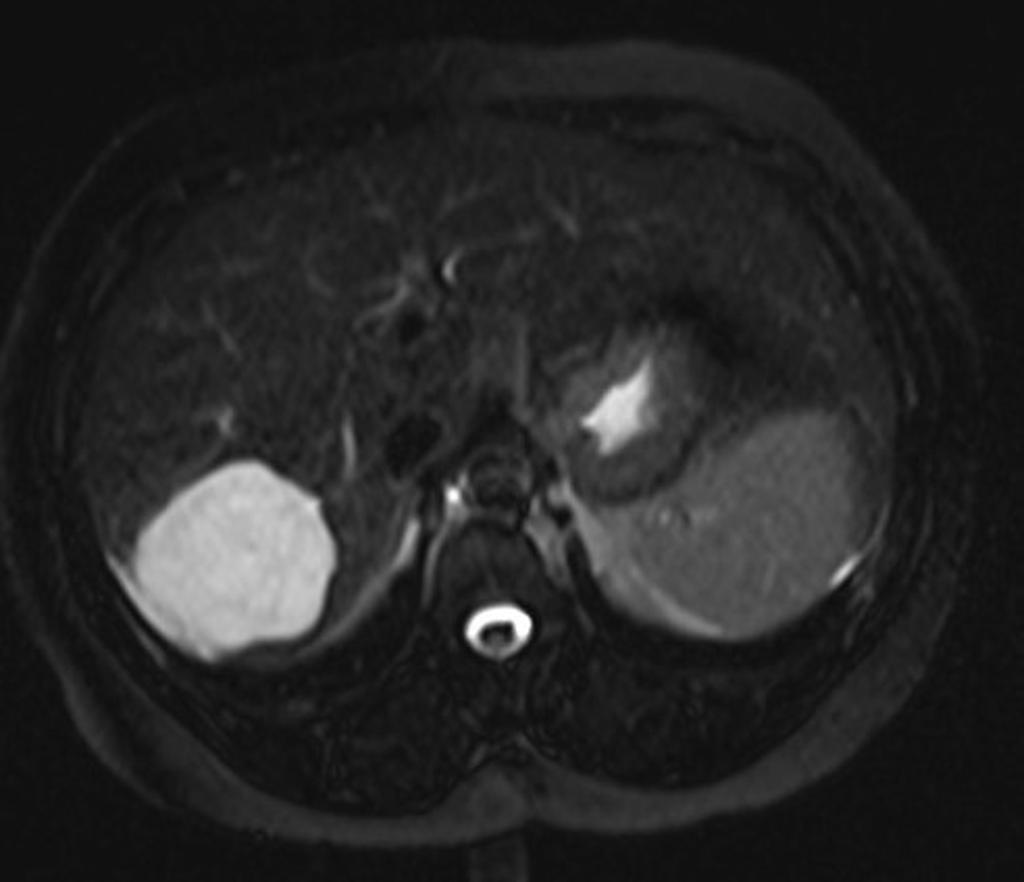 MRI reveals a lobullated T2 hyperintense lesion in the right lobe segments VI and VII.[2]