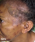 Lupus Erythematosus-Subacute Cutaneous Lupus Erythematosus. Adapted from Dermatology Atlas.[26]