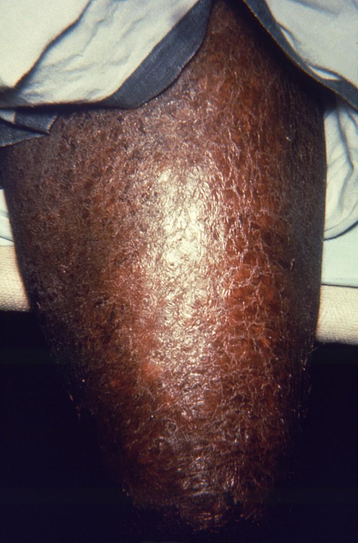 Lepromatous leprosy. Note erythema nodosum leprosum. Adapted from Public Health Image Library (PHIL), Centers for Disease Control and Prevention.[6]