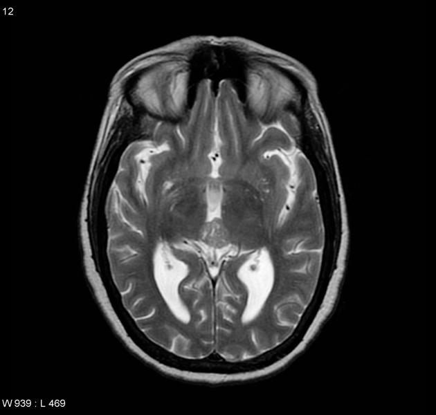 T2 MRI image demonstrating a well circumscribed mass is located in the region of the pineal gland. It is a little heterogeneous with multiple small regions of cyst formation (on T2) most marked anteriorly, probably at the site of biopsy.[21]