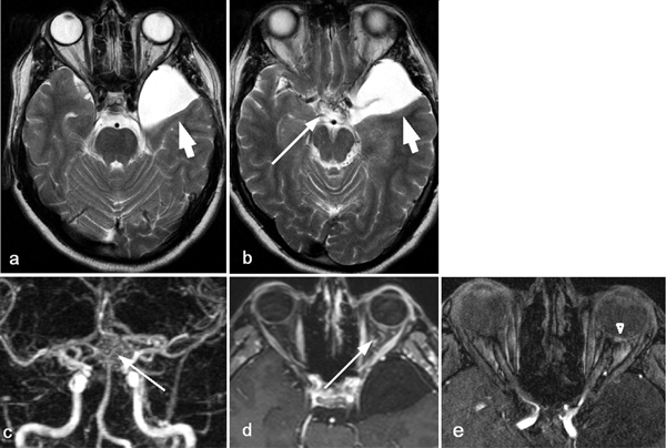 File:MRI showing a temporal arachnoidal cyst.jpg