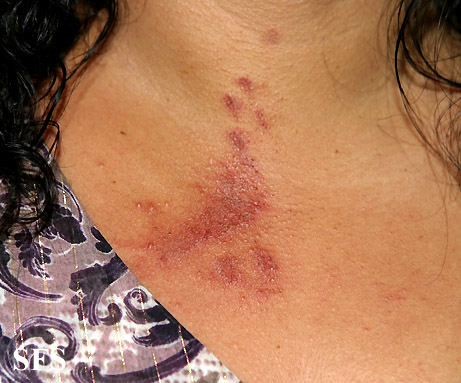 File:Paederus dermatitis03.jpg