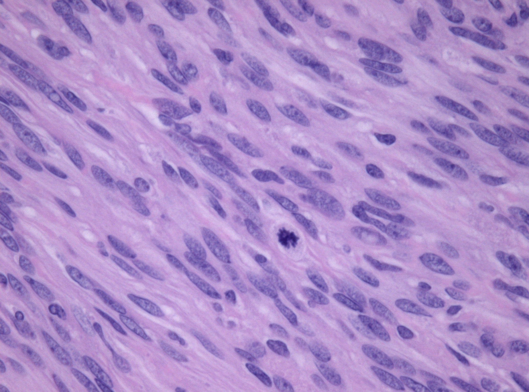 File:Prominent mitosis meningioma.jpg