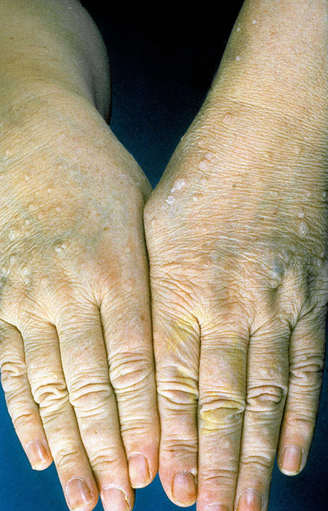 File:Trichilemmomas in Cowden Syndrome.gif