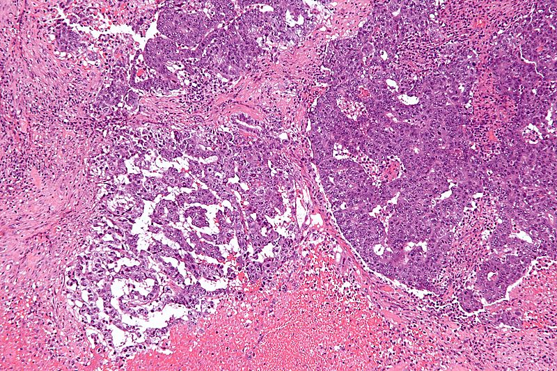 File:800px-Mixed germ cell tumour - intermed mag.jpg
