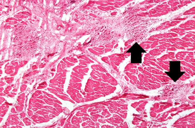 This is a higher-power photomicrograph of myocardium showing cellular accumulations--Aschoff bodies (arrows)--within the interstitium of the myocardium. These are found especially around blood vessels.
