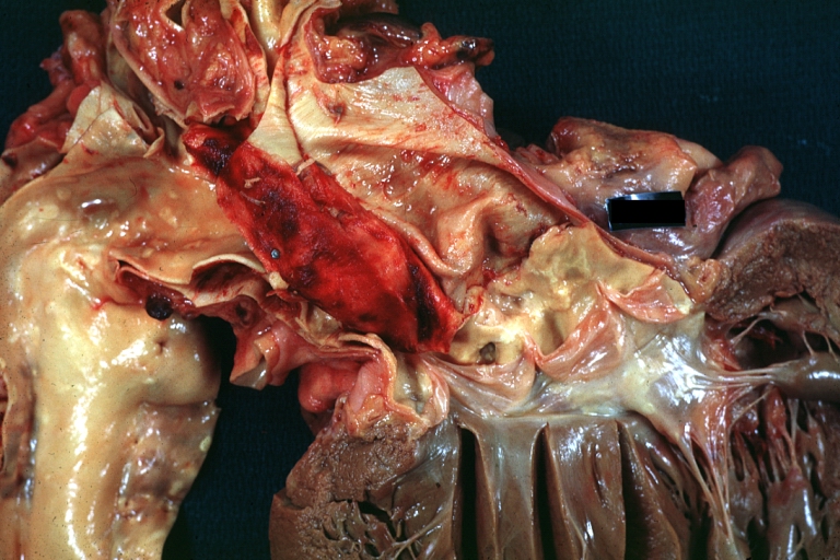 Dissecting Aneurysm: Gross, an excellent example, starting just above the aortic valve with reflection of aorta to show the dissection tract and some thrombus