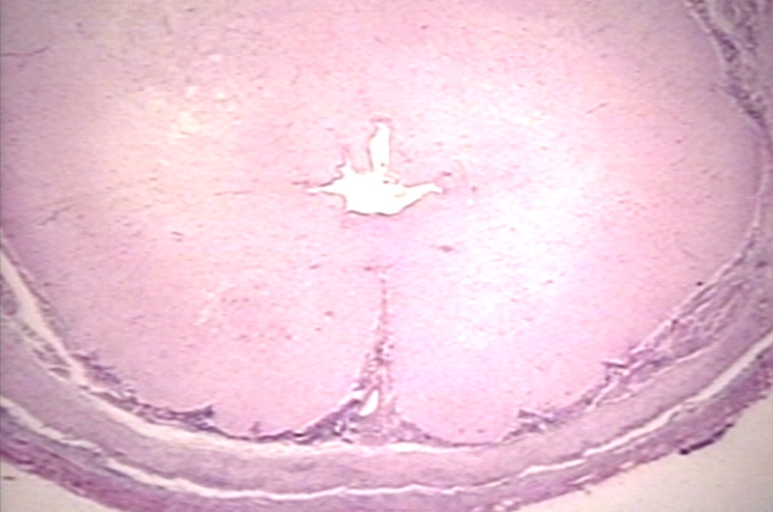 Spinal Cord: Arnold Chiari Malformation; Type II, Meningomyelitis