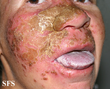 Candidiasis chronic mucocutaneos. Adapted from Dermatology Atlas.[4]