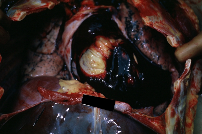 Hemopericardium: Gross, natural color, heart in situ with opened pericardium and filled with red blood clot (quite good example) dissecting aneurysm