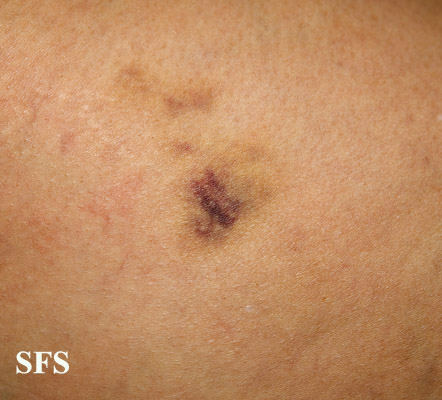 File:Painful bruising syndrome14.jpg