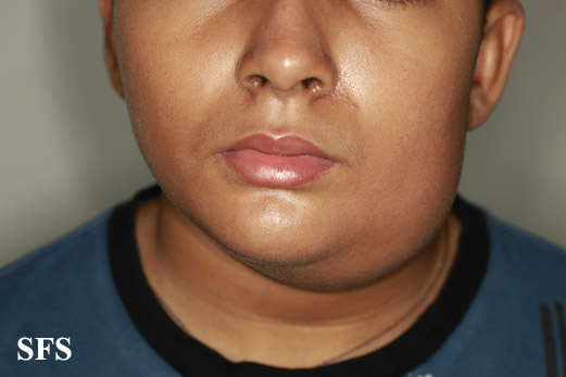Parotitis. With permission from Dermatology Atlas.[1]