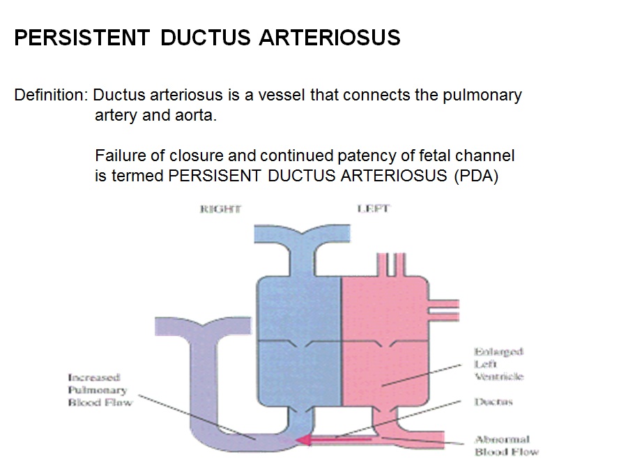 Patent ductus arteriosus pathophysiology - wikidoc