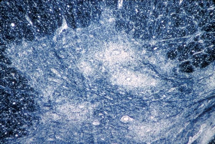 A photomicrograph of the cervical spinal cord in the region of the anterior horn revealing Polio Type III degenerative changes.Adapted from Public Health Image Library (PHIL), Centers for Disease Control and Prevention.[9]