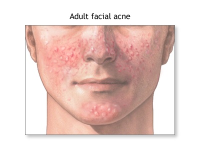 Acne may persist into adulthood.
