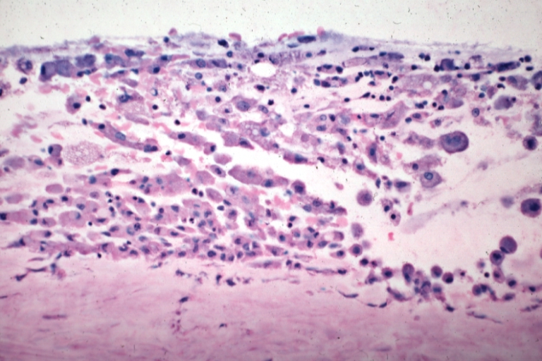 Saphenous vein coronary bypass graft: Atherosclerosis: Micro, high mag, subendothelial foam cells