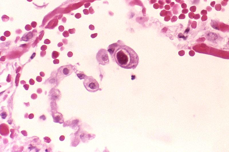 Typical "owl eye" inclusion indicating CMV infection of a lung pneumocyte[1]