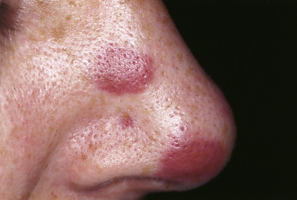 Violaceous lesions on the nose of Kaposi sarcoma. Source: Wikimedia Commons[12]