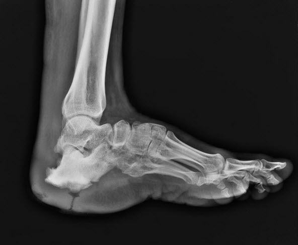 Air filled sinus tract leading to sclerosed, deformed calcaneum.