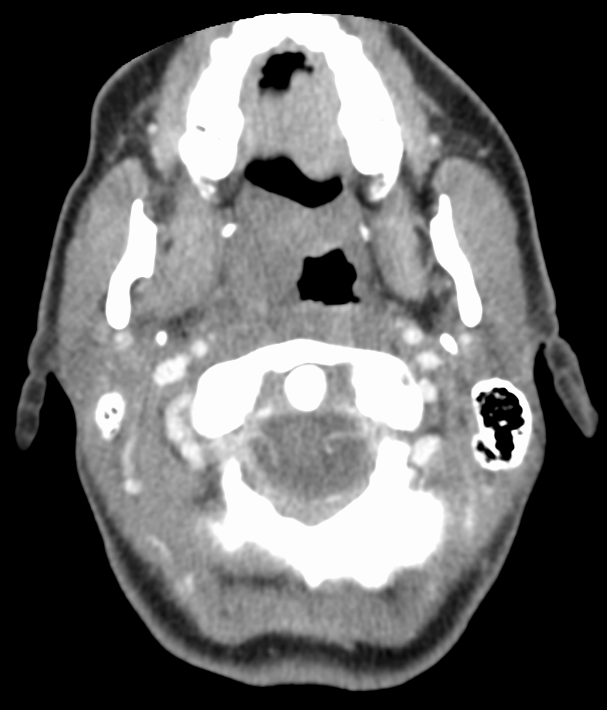 CT scan showing and right-sided peritonsillar abscess