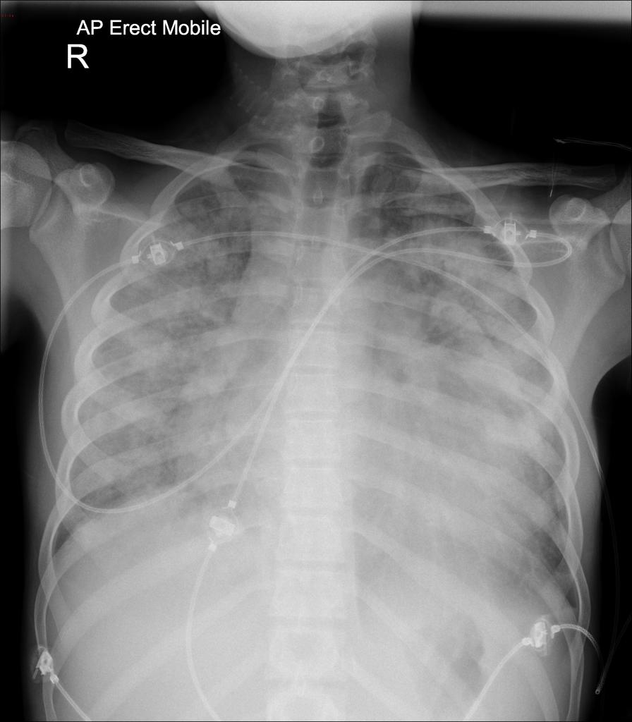 File:Acute Rheumatic Fever X-Ray 1.jpg