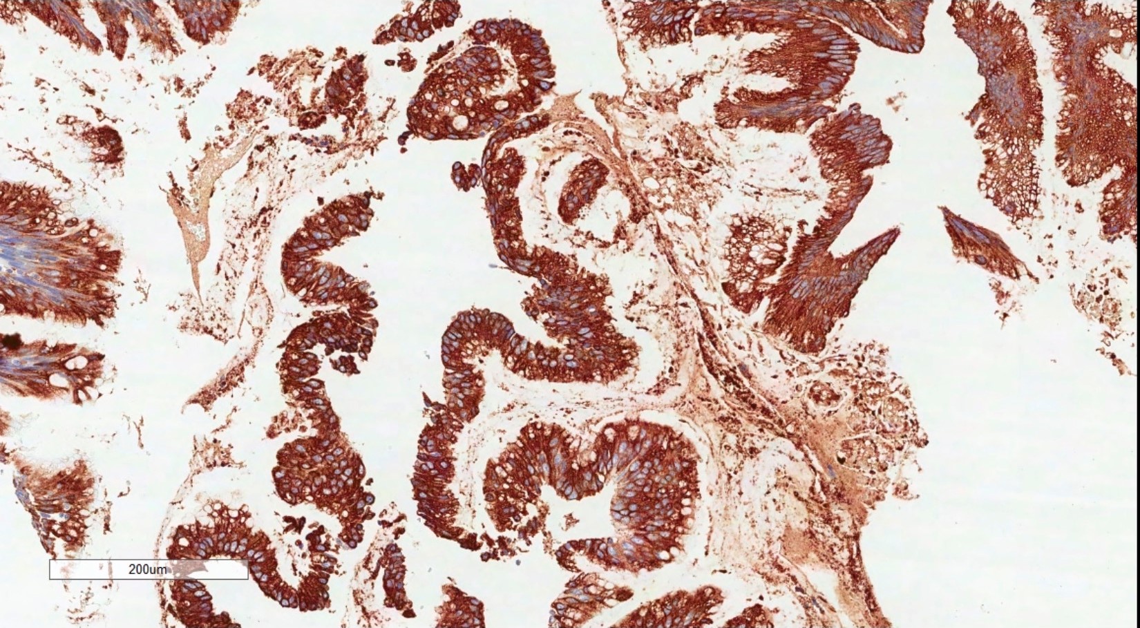 File:Adenocarcinoma of appendix, MUC2 staining.jpg
