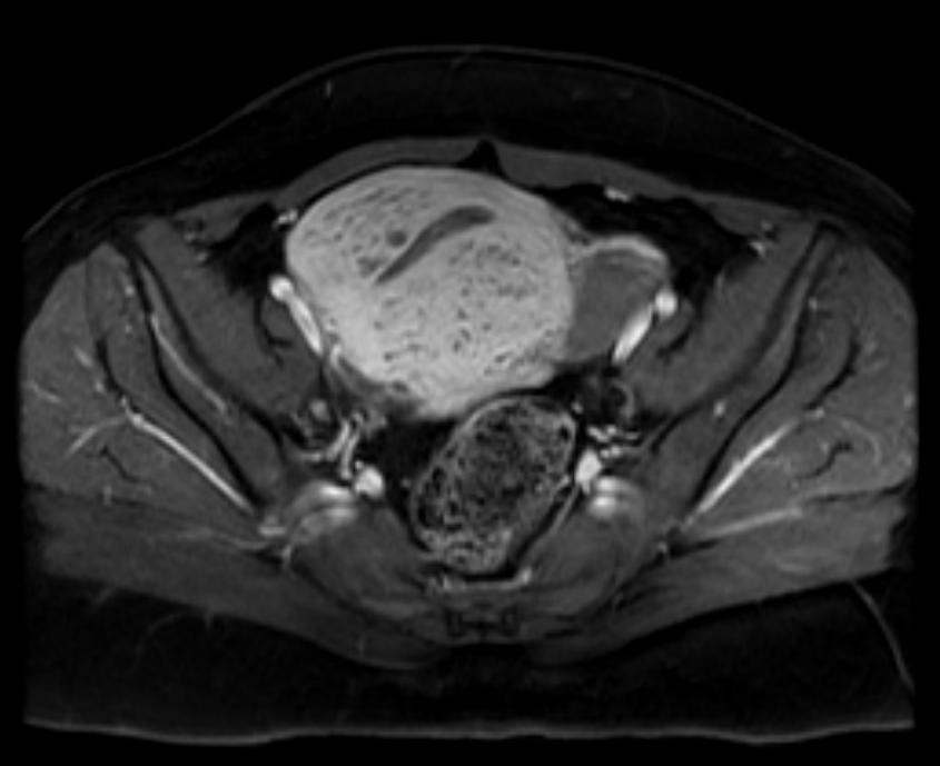 File:Adenomyosis MRI 107.jpg