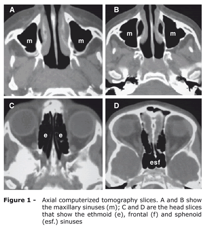 File:CT Scan of Normal paranasal sinuses.gif