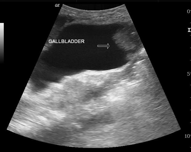 File:Gallbladder cancer.jpg