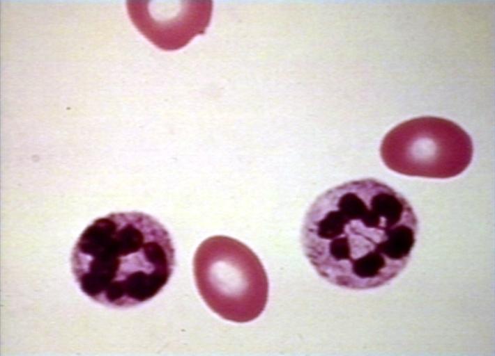 Megaloblastic anemia.jpg
