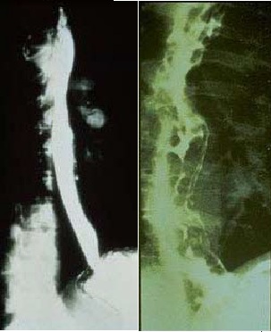 File:Normal versus Abnormal Barium study of esophagus.jpg