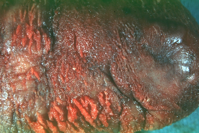 Fibrinous pericarditis: Gross, close-up, an excellent example of color and detail.