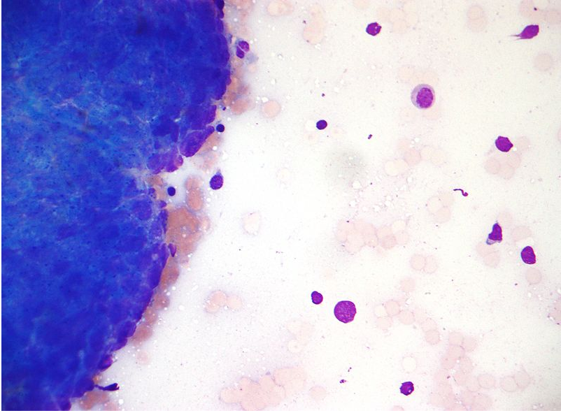 Micrograph of a Thymoma. FNA specimen. Field stain