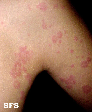 Urticaria. Adapted from Dermatology Atlas.[4]