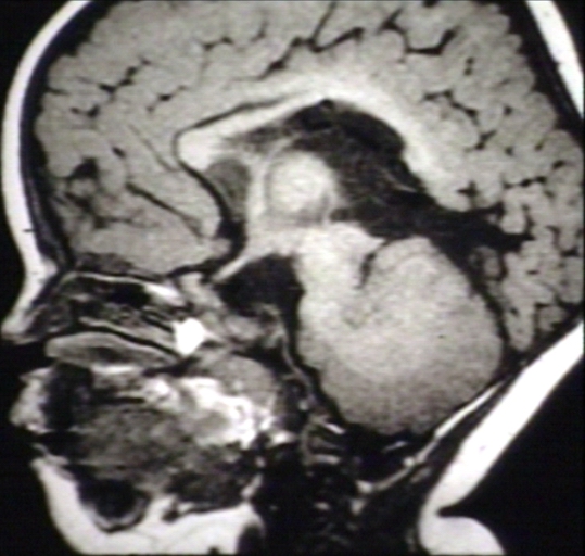 Brain: Arnold Chiari II, with Hypoplastic Corpus Callosum; T1 (MRI)