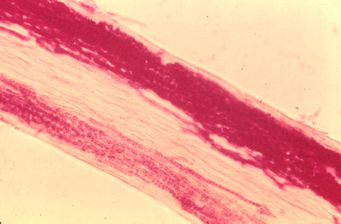 Ultrastructural pathologic changes that were exhibited by a hair shaft affected by an endothrix infection caused by the dermatophytic fungus, Trichophyton tonsurans (430x mag). From Public Health Image Library (PHIL). [1]