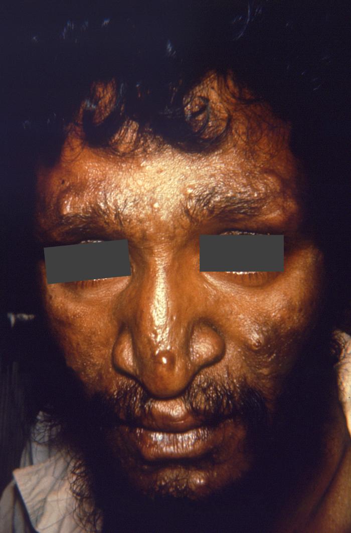 Nodular lepromatous or multibacillary leprosy. Note cutaneous nodules upon the forehead, nose, cheeks, lips, and chin, as well as diminished eyebrows.Adapted from Public Health Image Library (PHIL), Centers for Disease Control and PreventionPublic Health Image Library (PHIL), Centers for Disease Control and Prevention[5]
