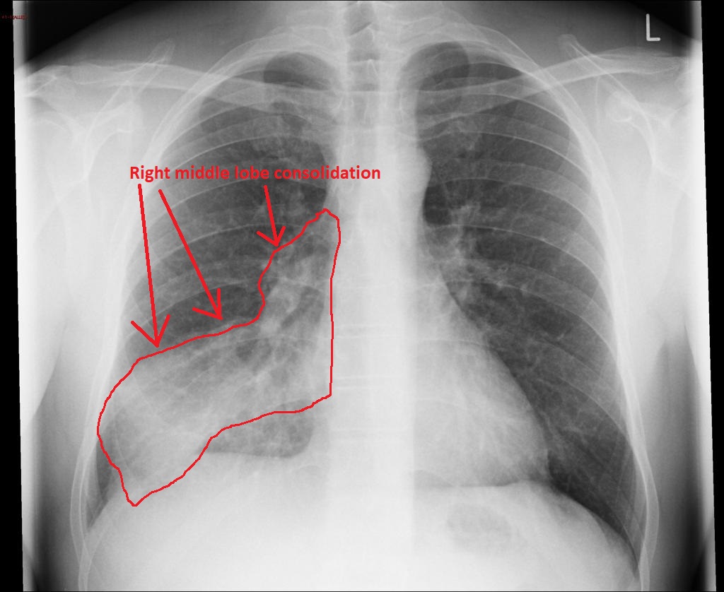 Pneumonia Chest X Ray Wikidoc
