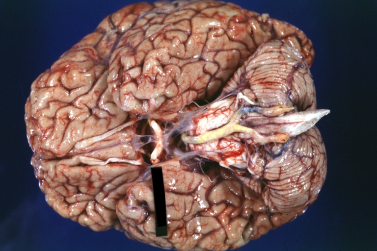 Brain: Basilar Artery Atherosclerosis: Gross, fixed tissue, an external view of base of brain (typical lesion)