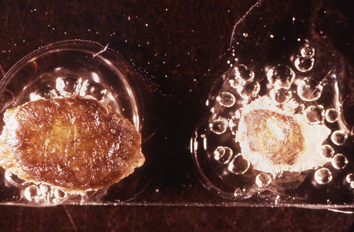 Viewed from above, this image depicts a smallpox scab (left), and chickenpox scab (right) as a demonstration in comparative morphology. From Public Health Image Library (PHIL). [3]