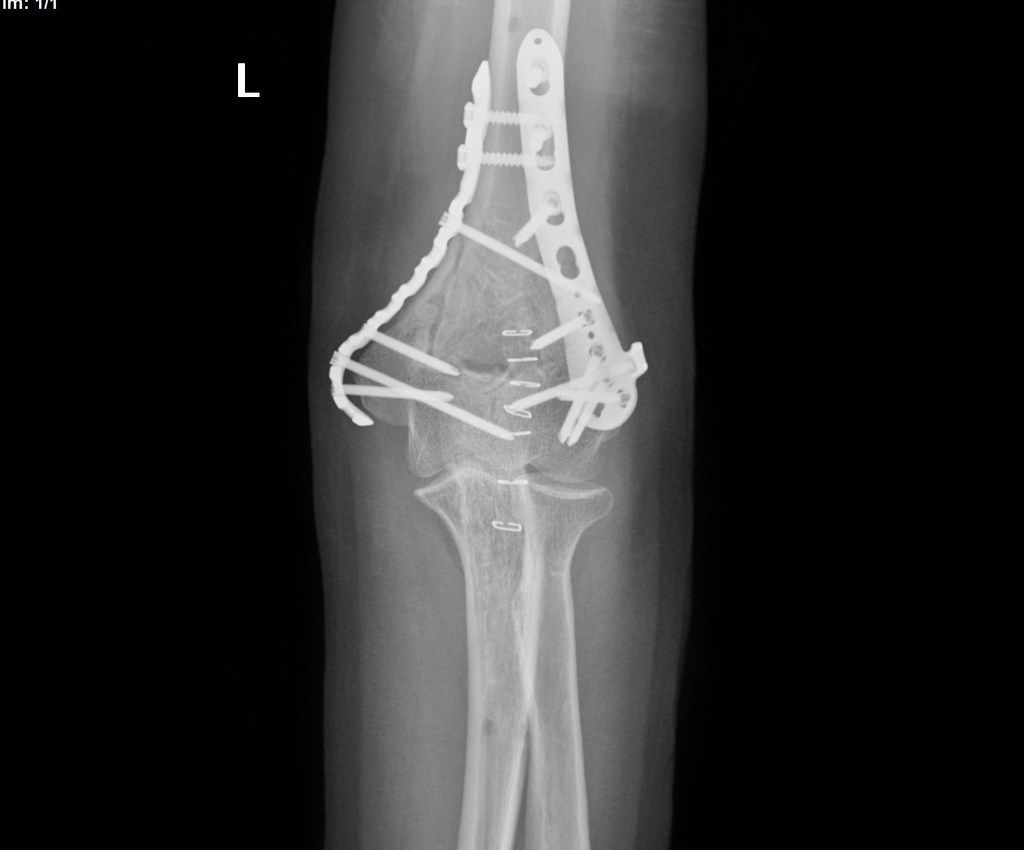 External fixation and pinning was done initially followed by open reduction and internal fixation with satisfactory alignment.