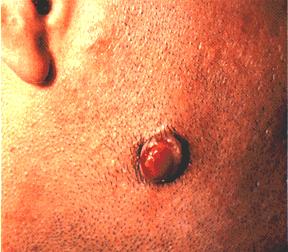 Kaposi Sarcoma: Angiomatous Nodule Image obtained from U.S. Department of Veterans Affairs - Image Library [10] (Toby A. Maurer, MD, Timothy G. Berger, MD, University of California San Francis )