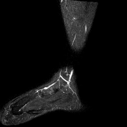Small subtle non displaced fissure fracture of persistent dark signal intensity is seen traversing the anterior beak of the Rib bone with surrounding extensive marrow edema signal eliciting high signal at STIR WI.