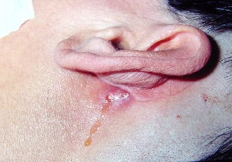 This patient has a recurrent cholesteatoma which has found its way to the surface of the post-auricular skin, forming a mastoid cutaneous fistula.[8]