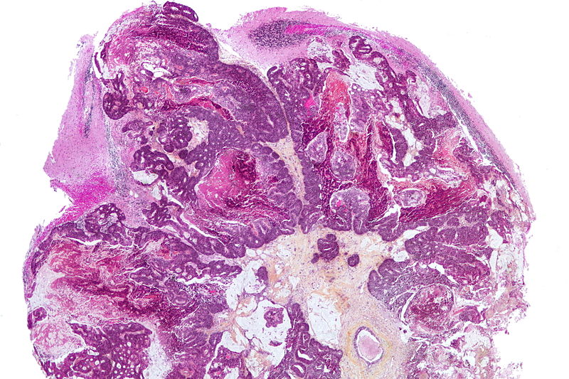 Very low magnification micrograph demonstrating metastatic adenocarcinoma that from a colorectal primary, i.e. colorectal carcinoma, by immunostains on HPS stain. The cerebellum seen on the image has Bergmann gliosis and Purkinje cell loss.[8]
